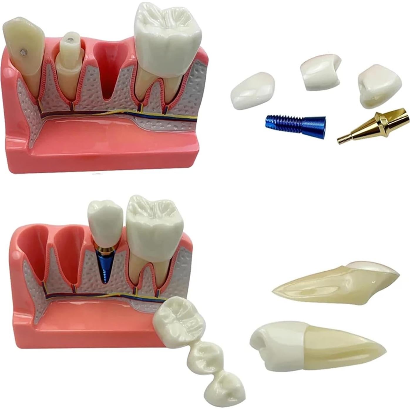 Modelo de Implante Dental 4 Dientes con Puente Removible