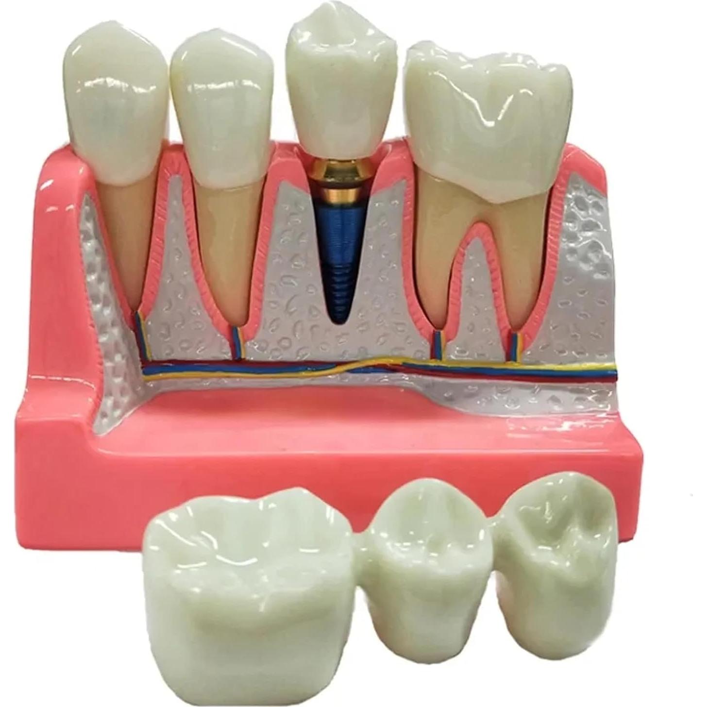 Modelo de Implante Dental 4 Dientes con Puente Removible