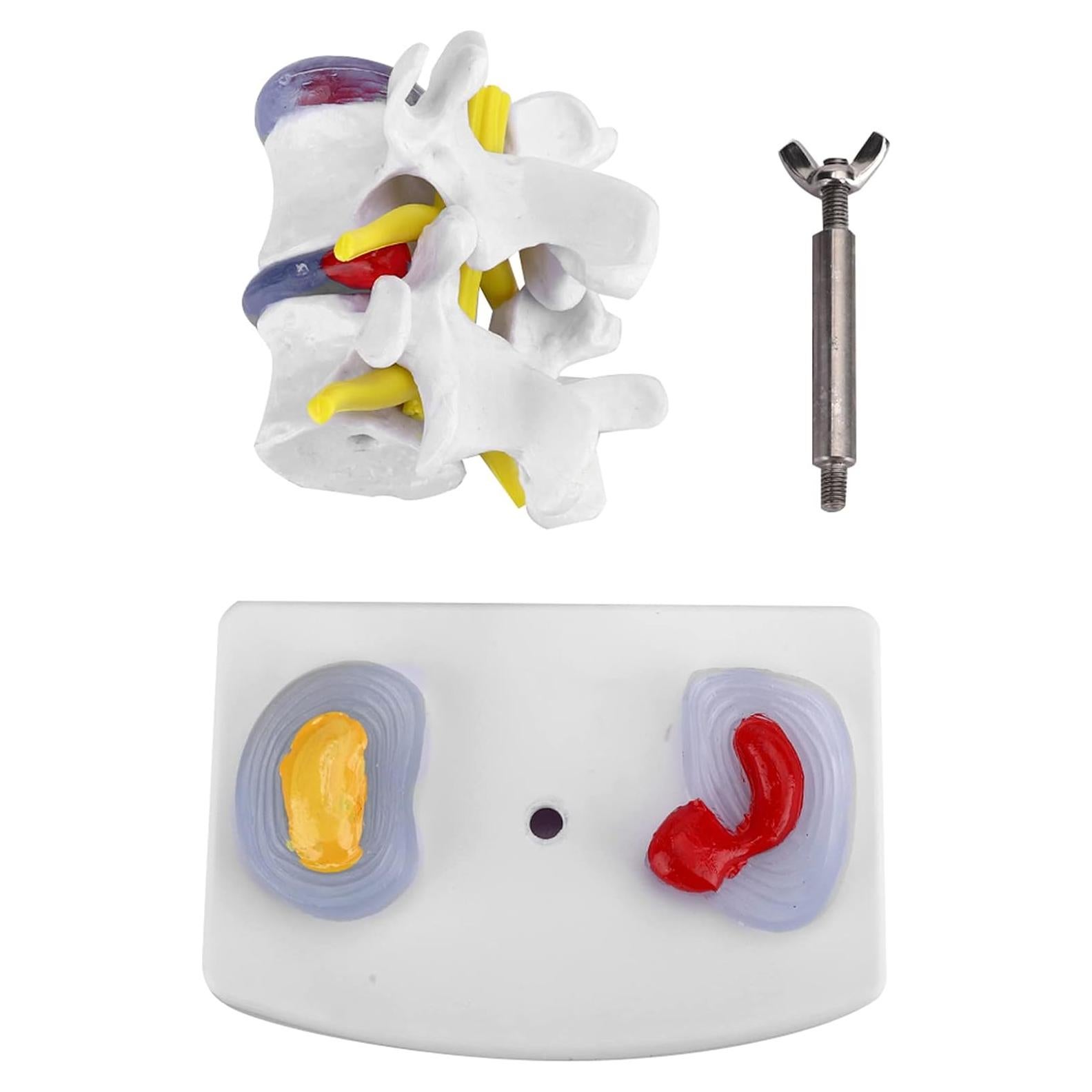 Modelo de Columna Vertebral YUYTE con Hernia de Disco Lumbar