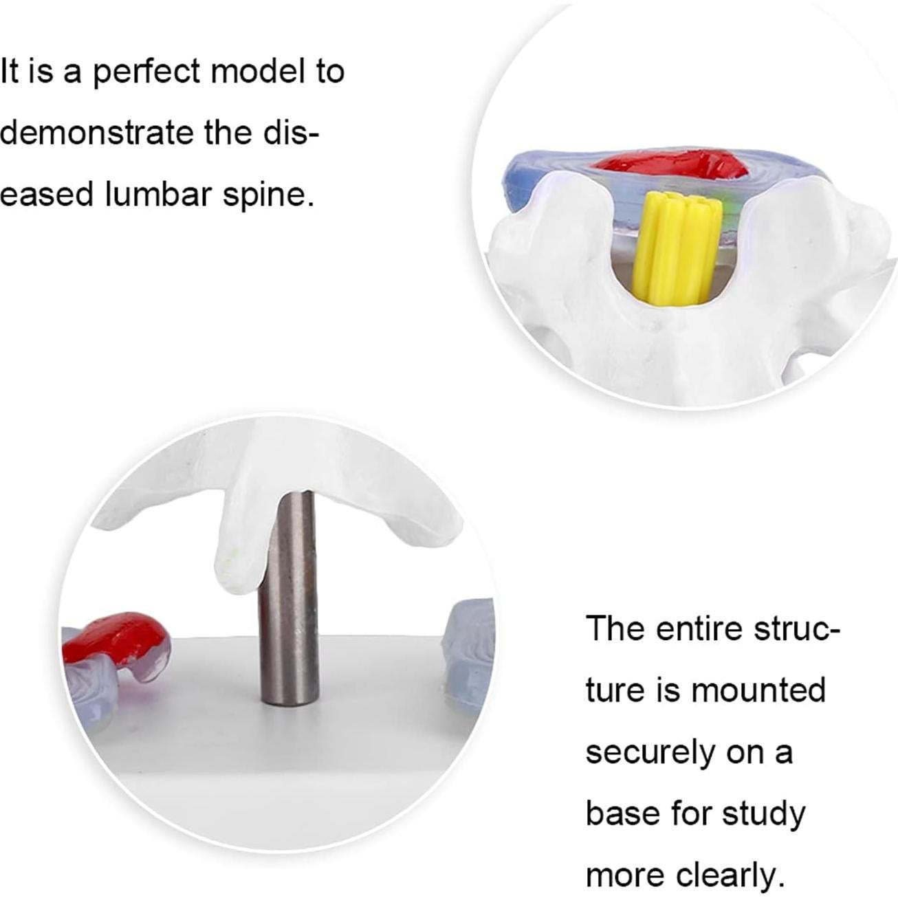 Modelo de Columna Vertebral YUYTE con Hernia de Disco Lumbar