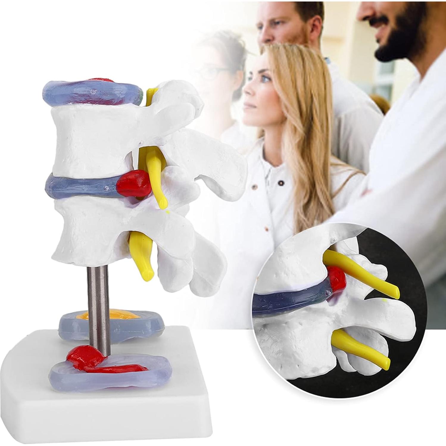 Modelo de Columna Vertebral YUYTE con Hernia de Disco Lumbar