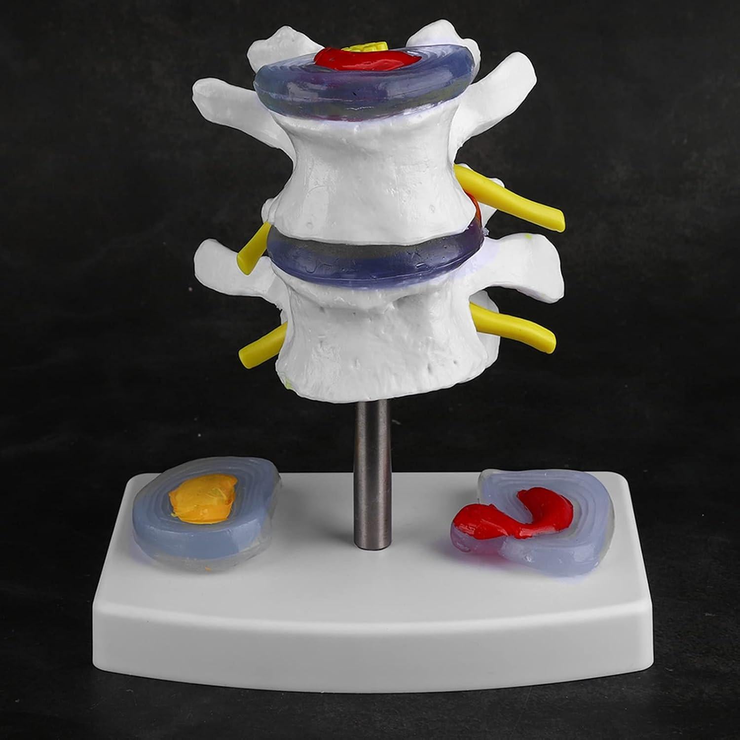 Modelo de Columna Vertebral YUYTE con Hernia de Disco Lumbar