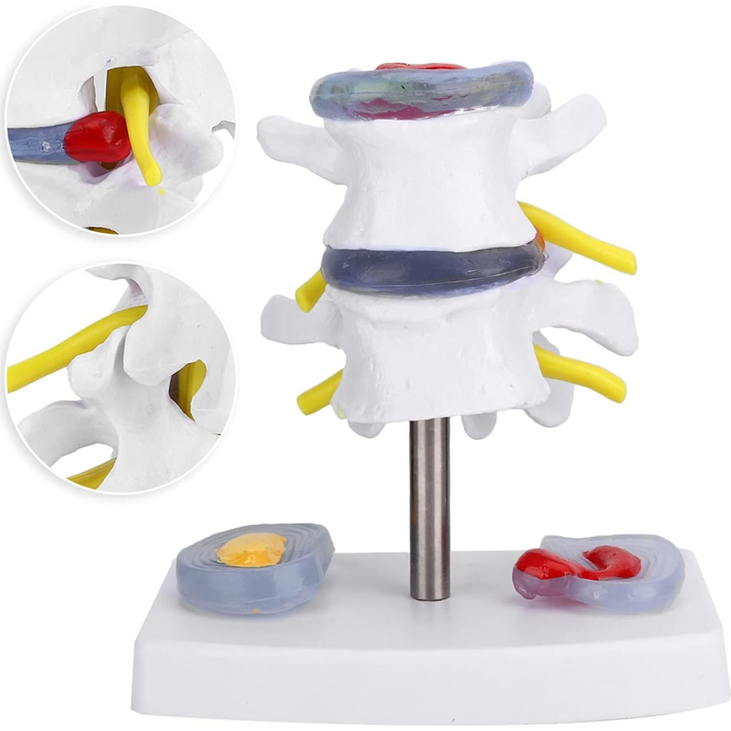 Modelo de Columna Vertebral YUYTE con Hernia de Disco Lumbar