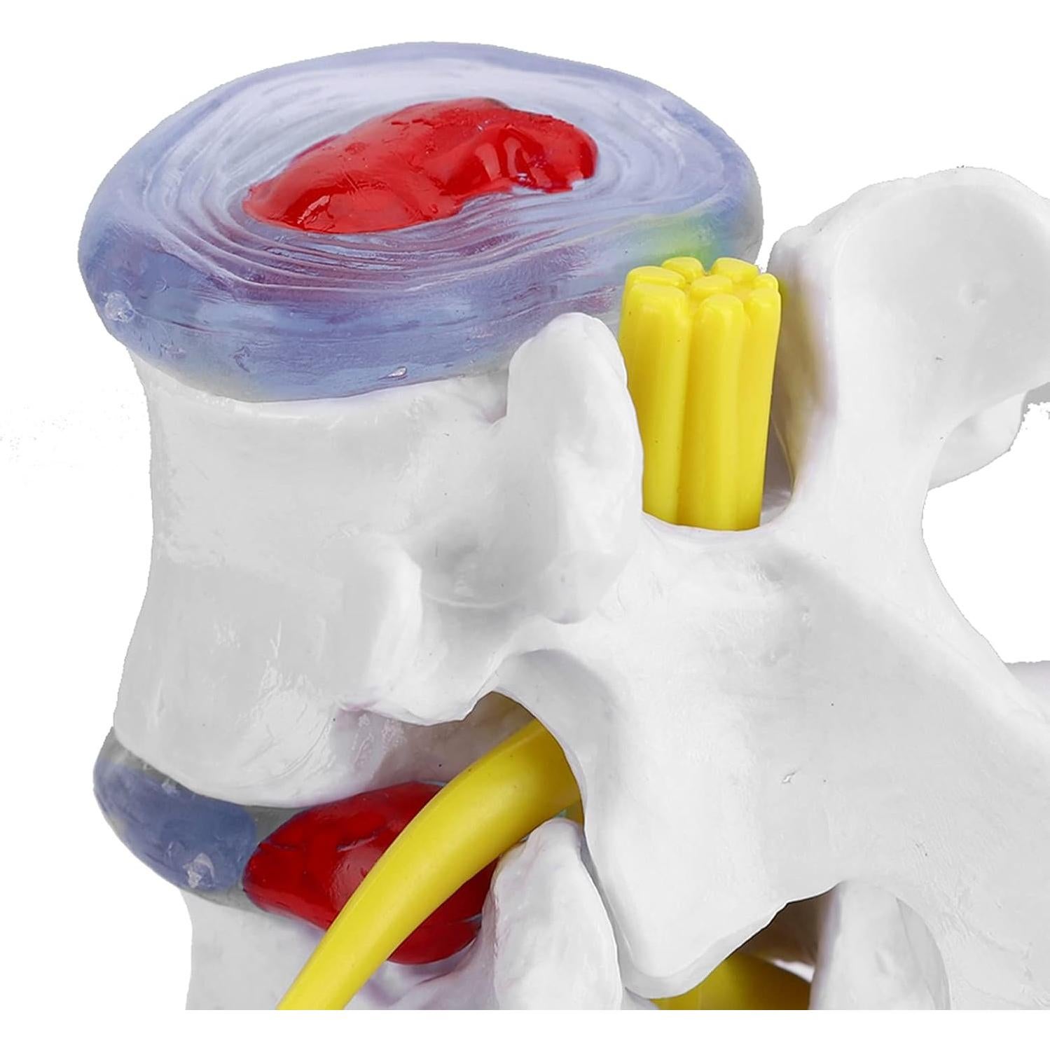Modelo de Columna Vertebral YUYTE con Hernia de Disco Lumbar