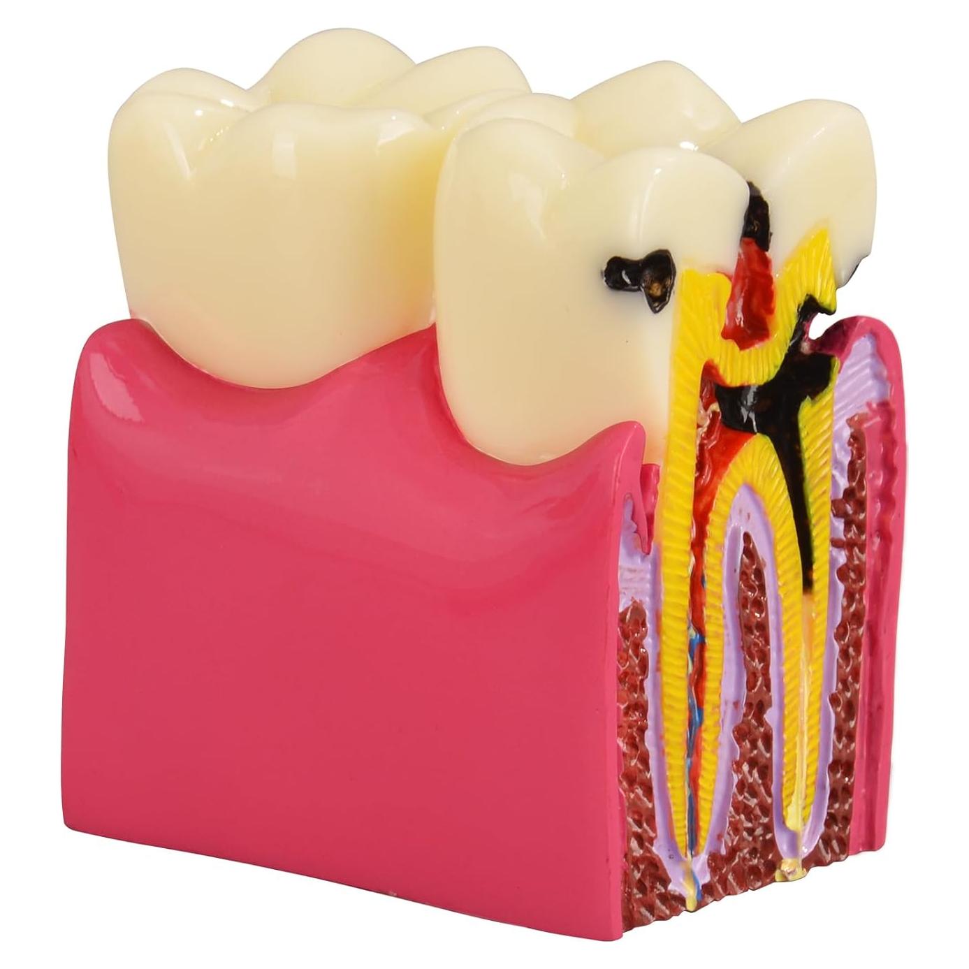 Modelo de Caries Dental Ultrassist 6 Veces Educativo 11x8.5cm