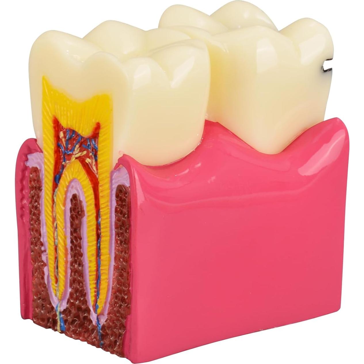 Modelo de Caries Dental Ultrassist 6 Veces Educativo 11x8.5cm