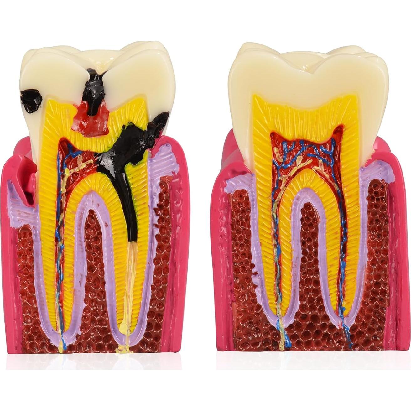 Modelo de Caries Dental Ultrassist 6 Veces Educativo 11x8.5cm