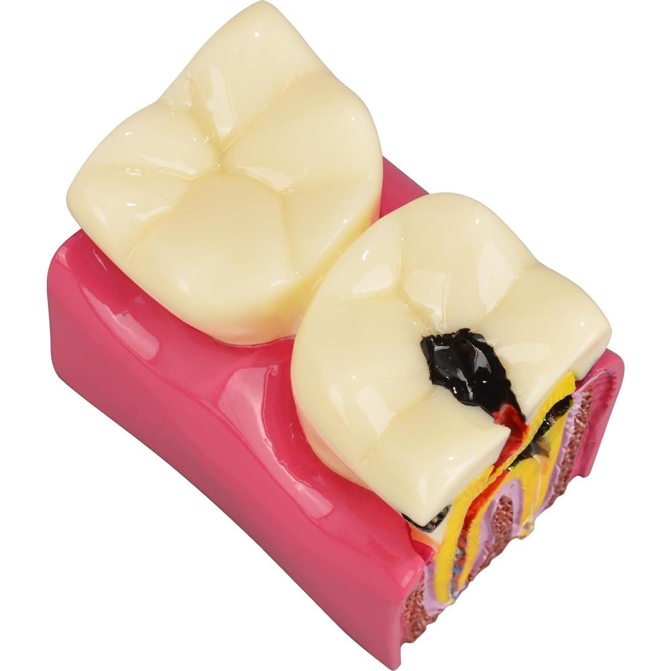 Modelo de Caries Dental Ultrassist 6 Veces Educativo 11x8.5cm