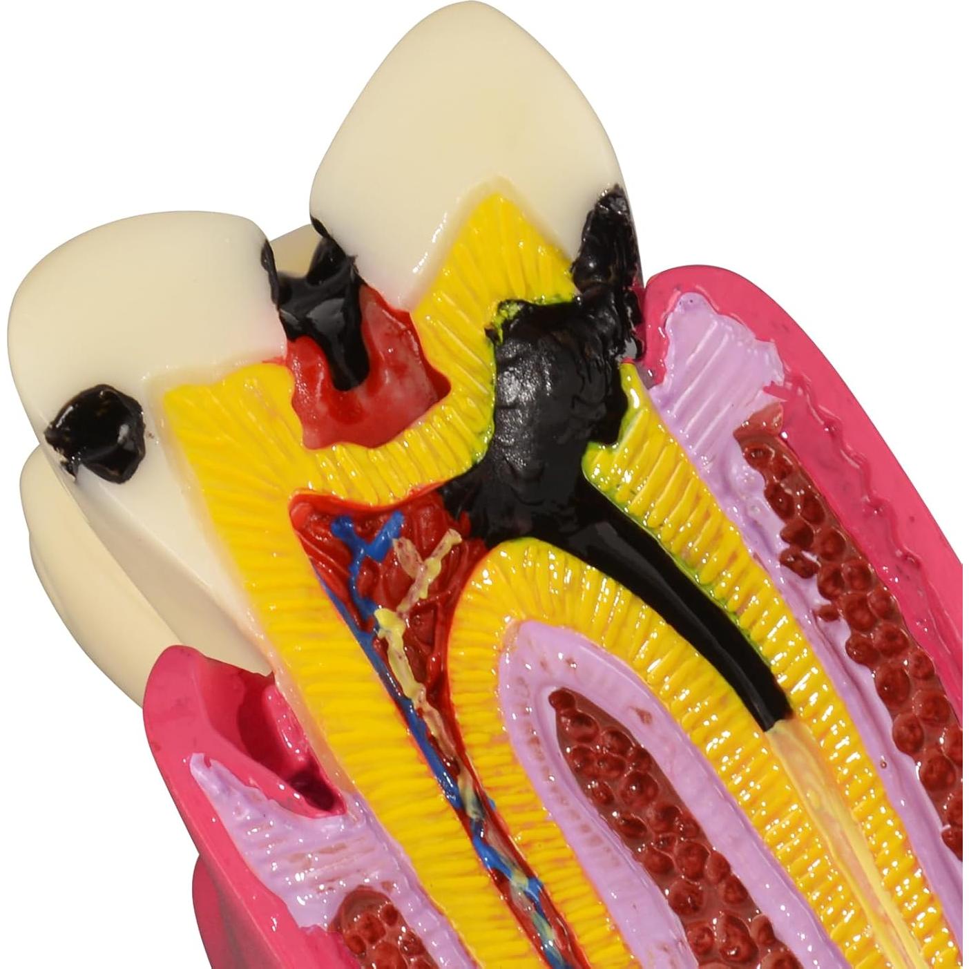 Modelo de Caries Dental Ultrassist 6 Veces Educativo 11x8.5cm