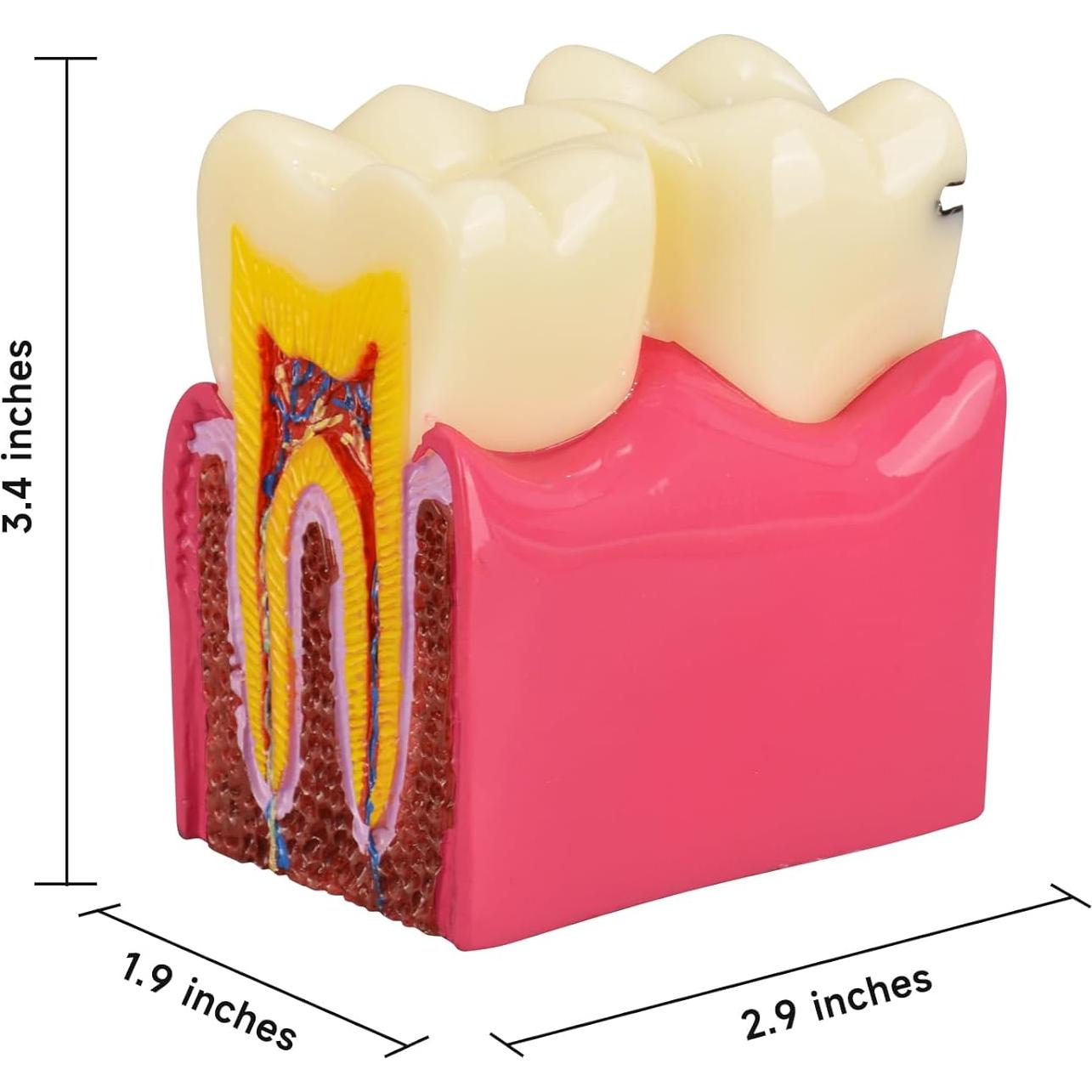 Modelo de Caries Dental Ultrassist 6 Veces Educativo 11x8.5cm