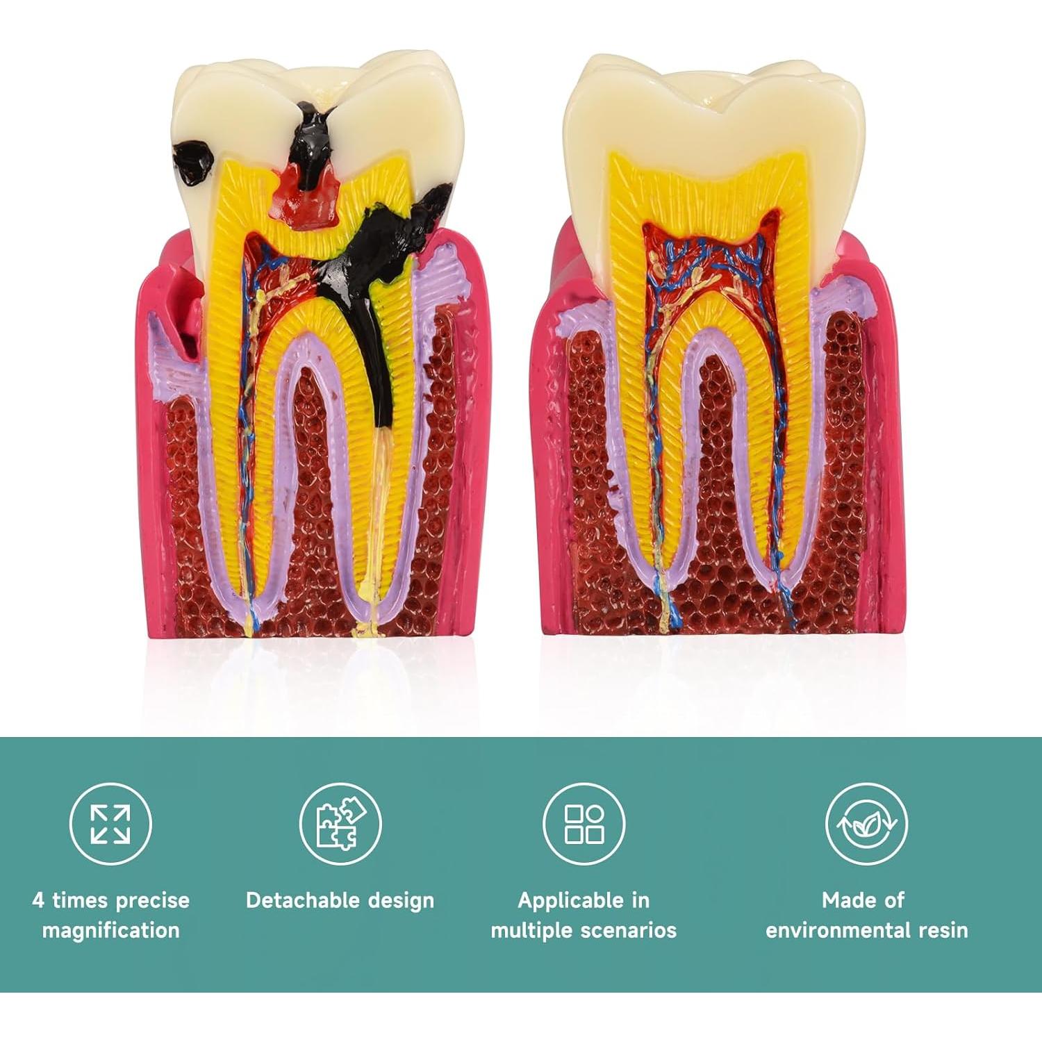 Modelo de Caries Dental Ultrassist 6 Veces Educativo 11x8.5cm