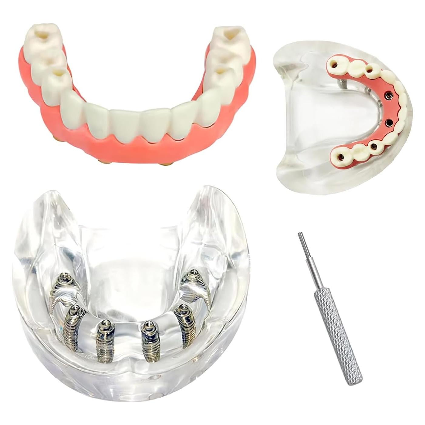 Modelo de Sobredentadura Dental Inferior Tangshan 7x6cm