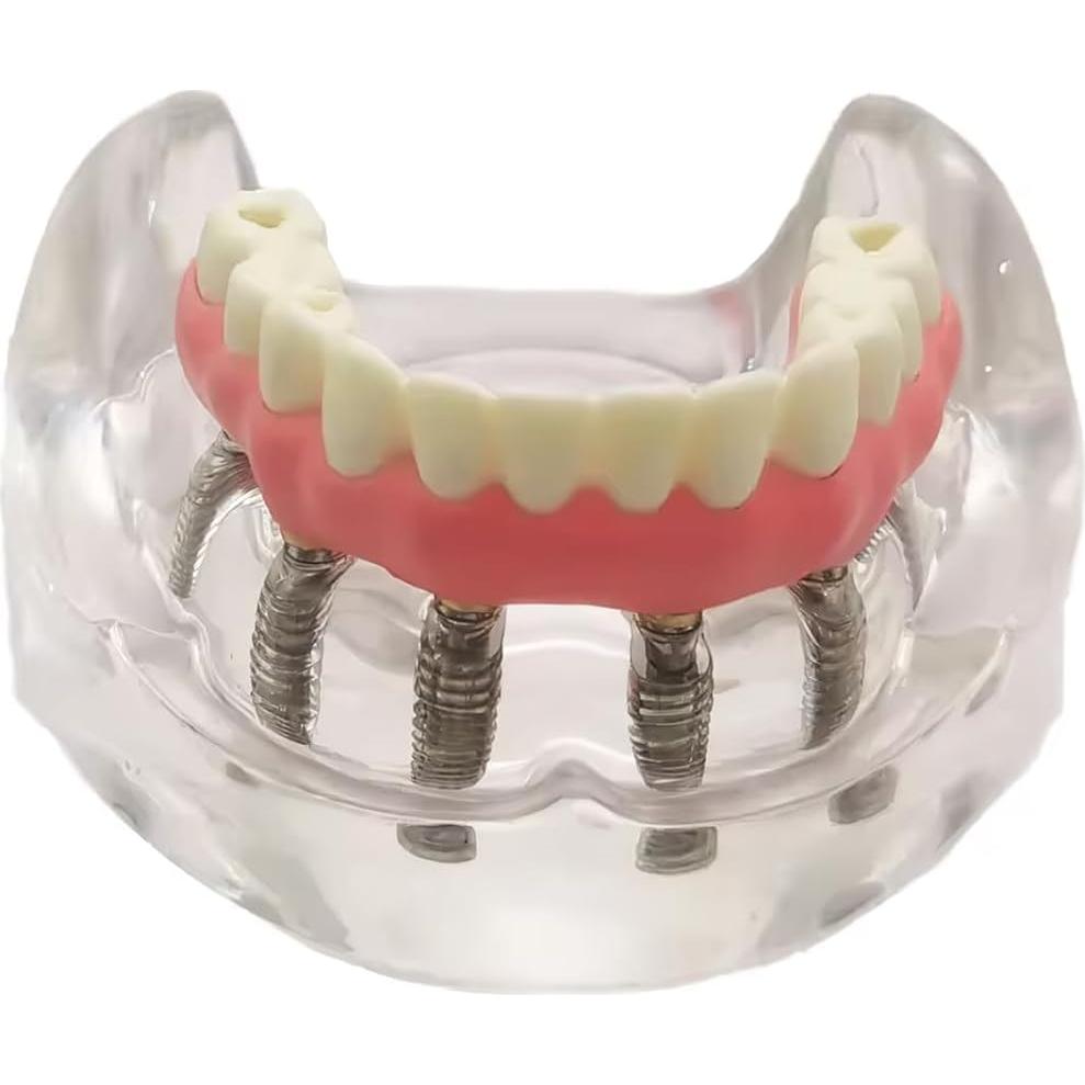 Modelo de Sobredentadura Dental Inferior Tangshan 7x6cm