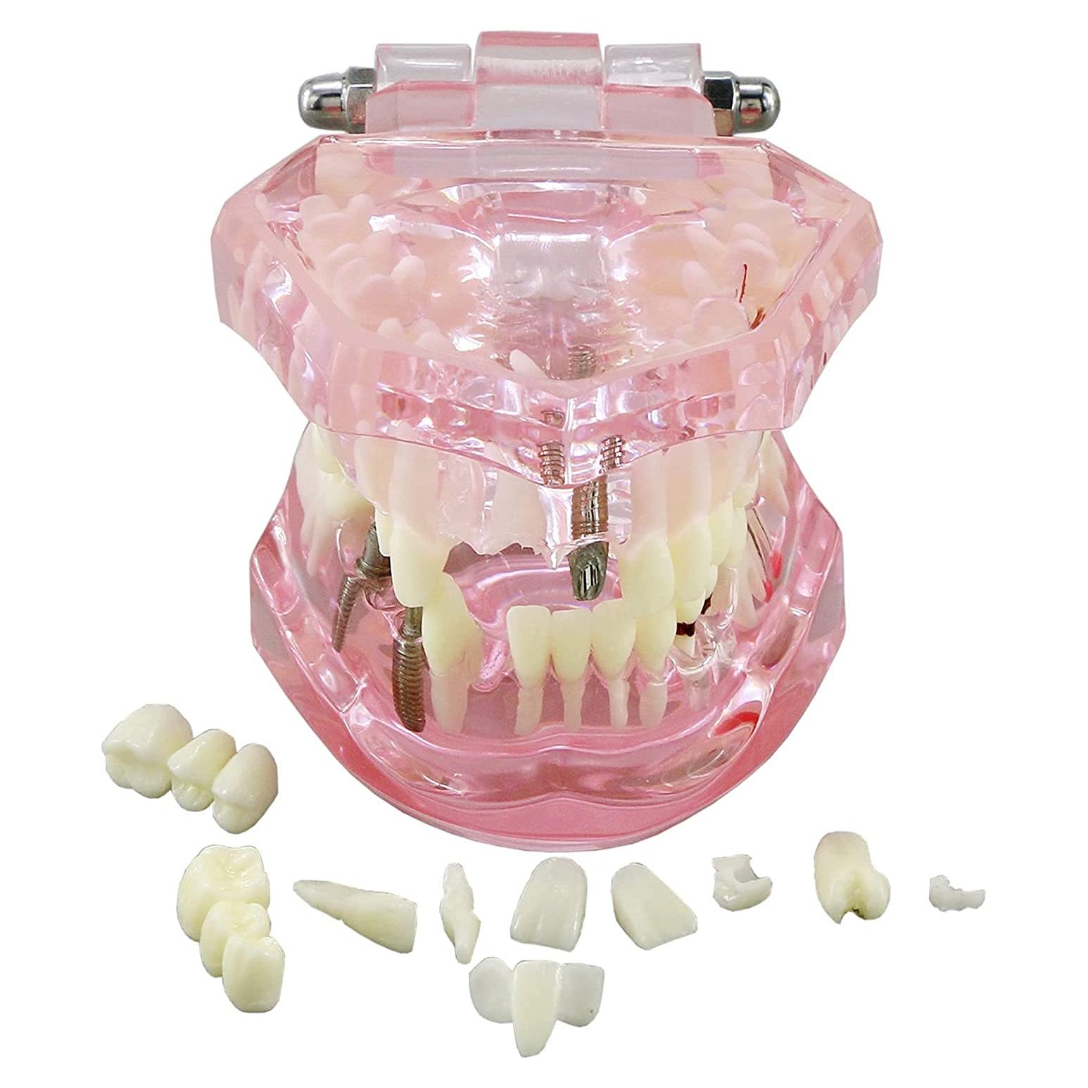 Modelo de Diente Typodont para Implantes Dentales 2001P