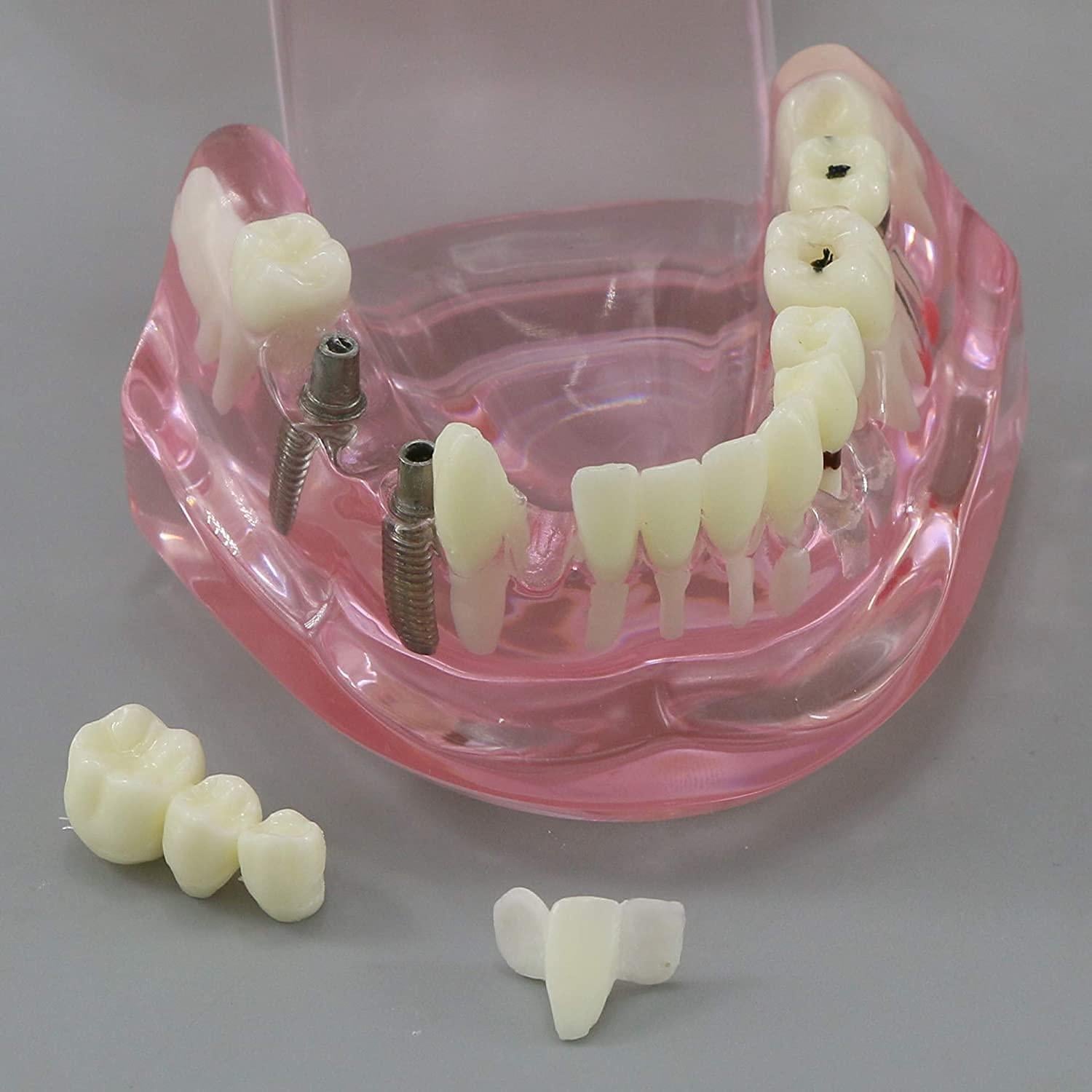 Modelo de Diente Typodont para Implantes Dentales 2001P
