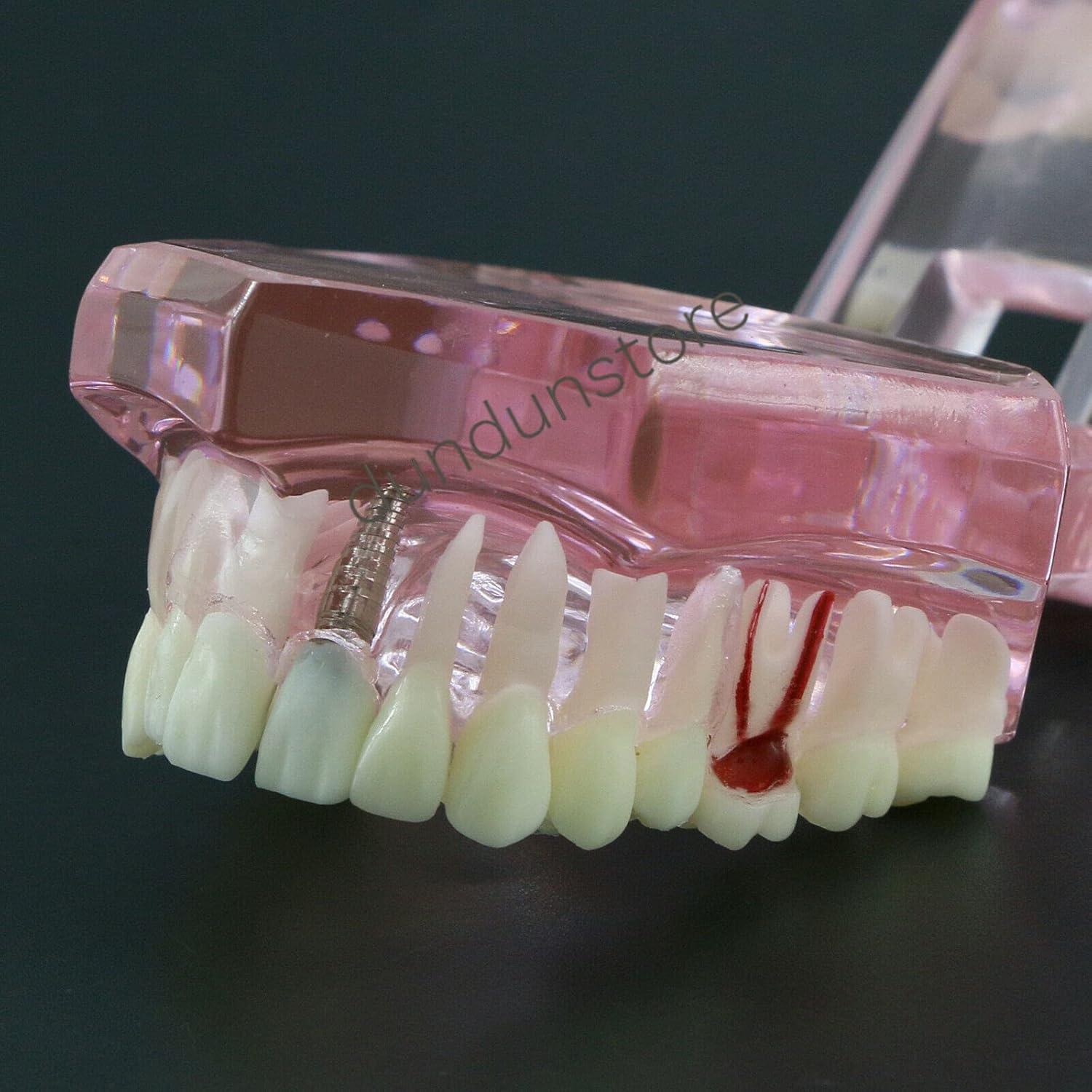 Modelo de Diente Typodont para Implantes Dentales 2001P