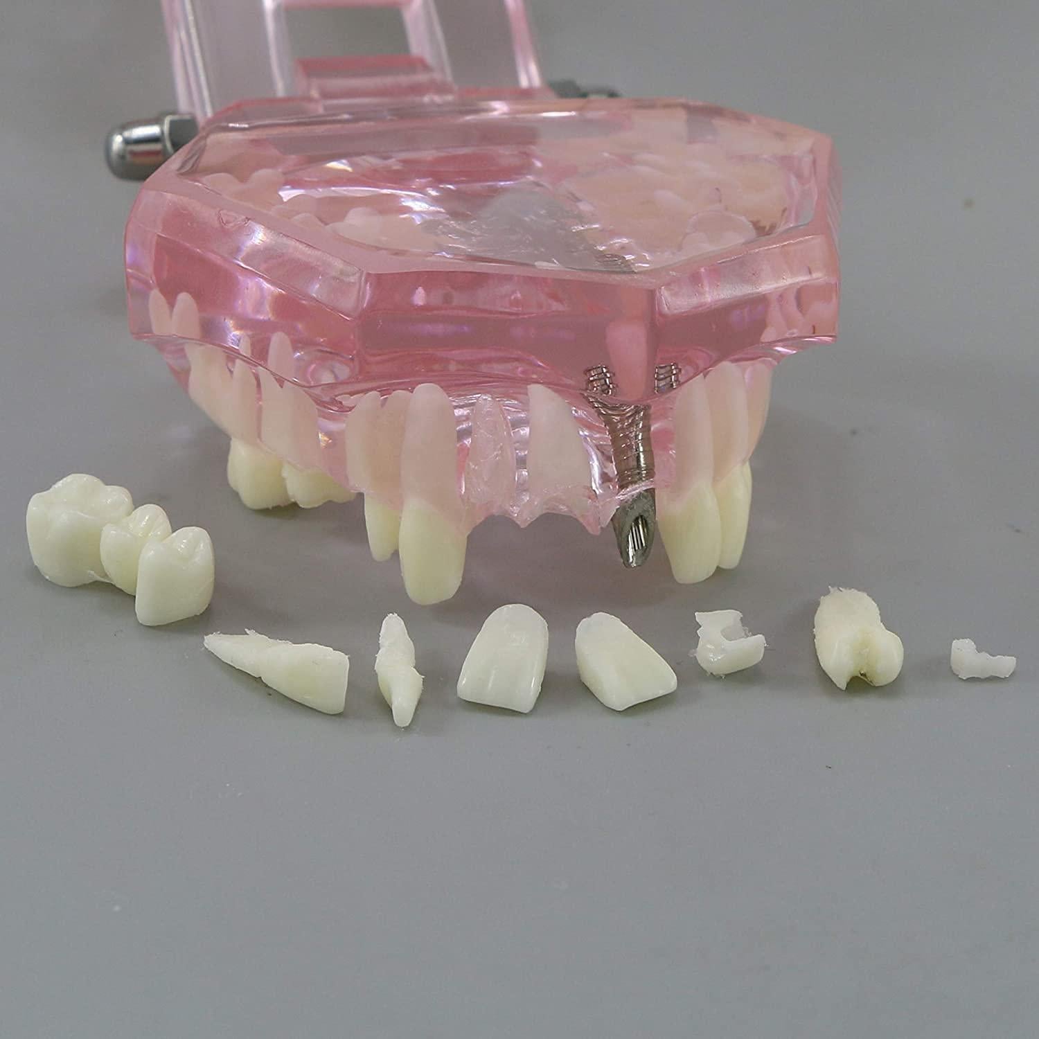 Modelo de Diente Typodont para Implantes Dentales 2001P
