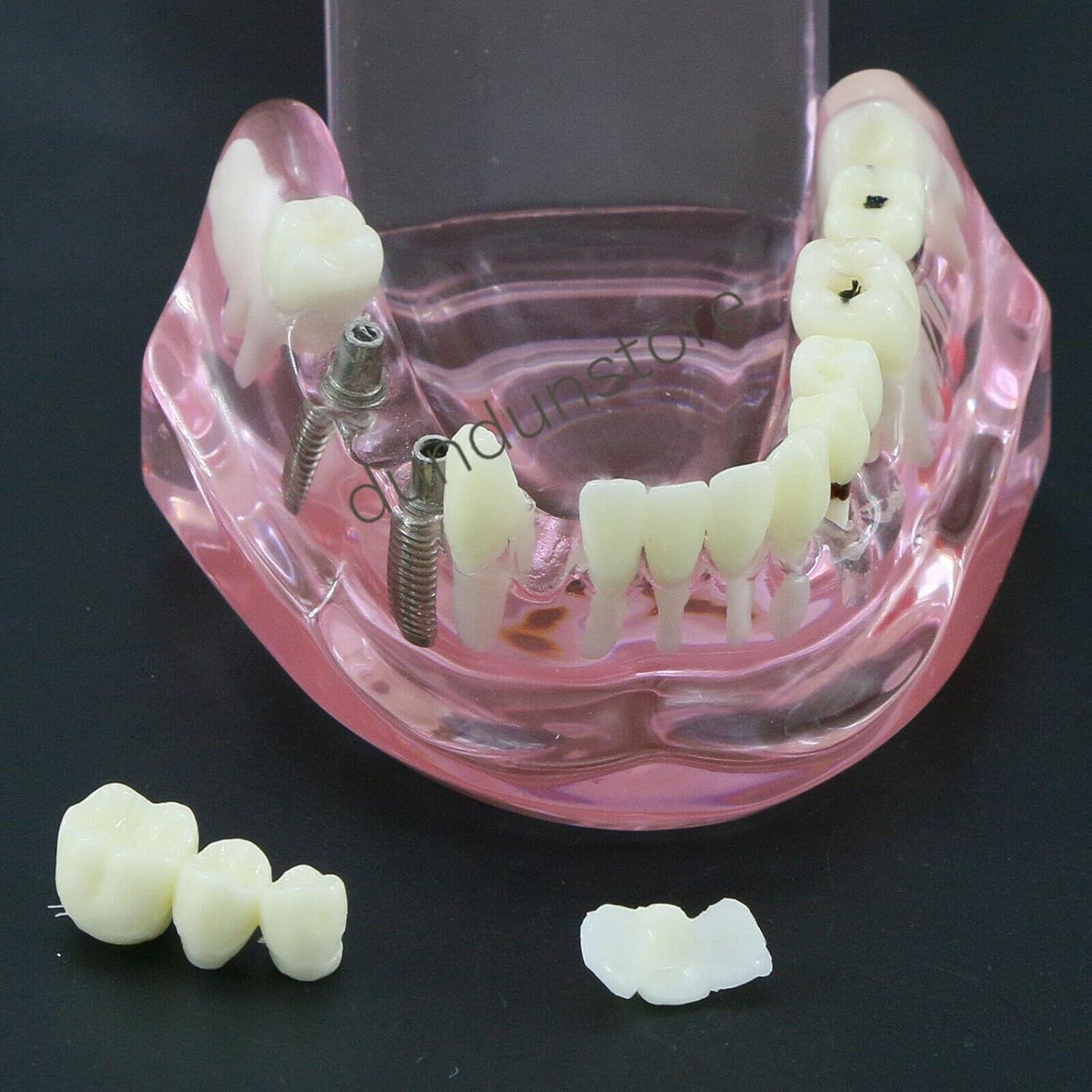 Modelo de Diente Typodont para Implantes Dentales 2001P