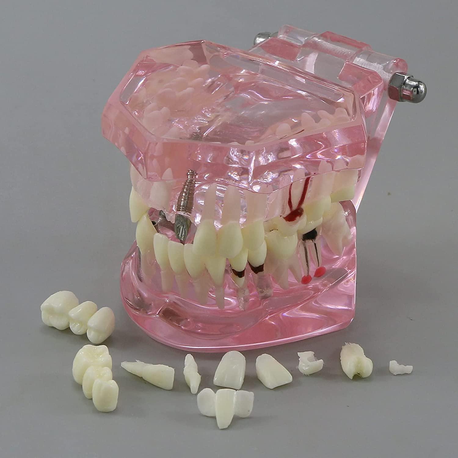Modelo de Diente Typodont para Implantes Dentales 2001P