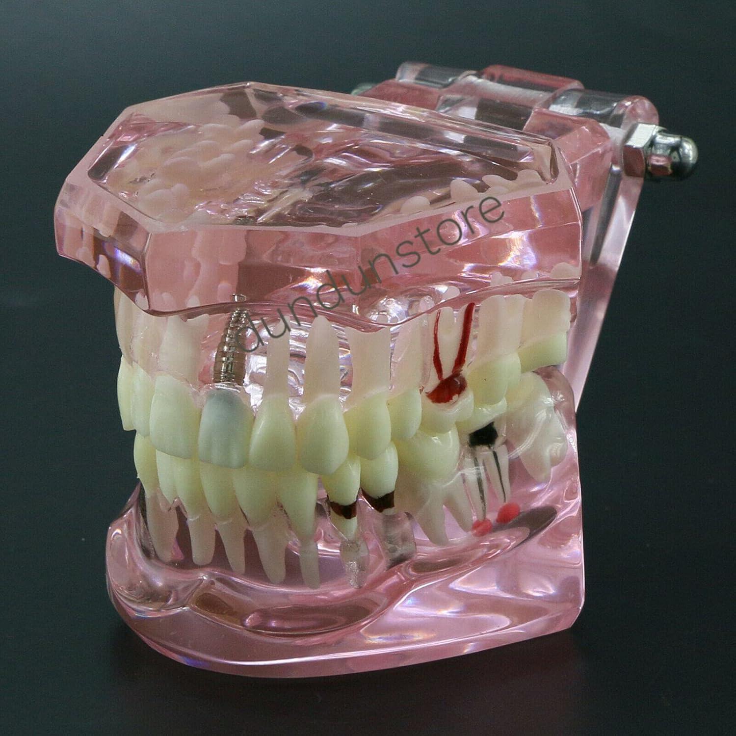 Modelo de Diente Typodont para Implantes Dentales 2001P