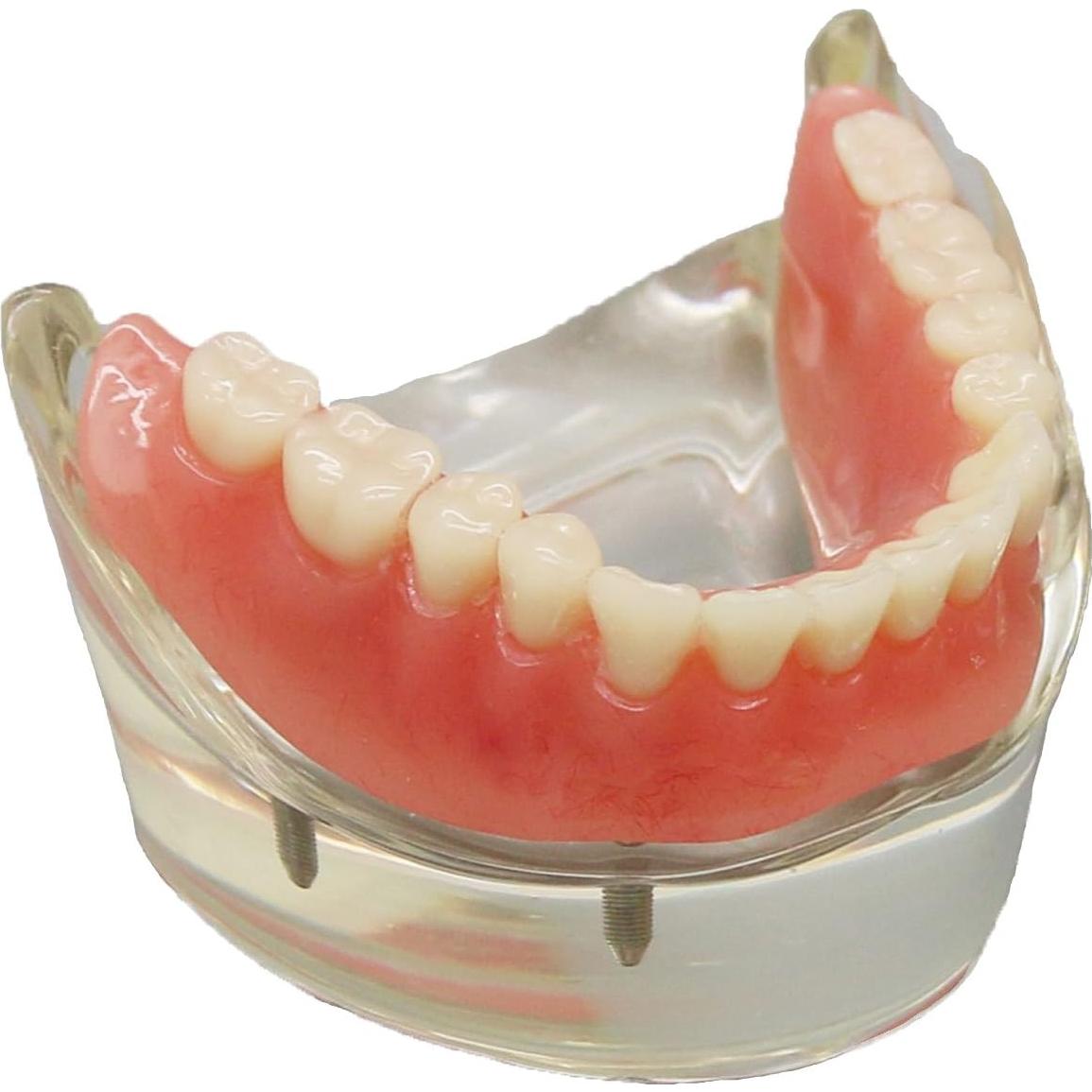 Modelo Dental Sobredentadura Inferior Smile1000 4 Implantes