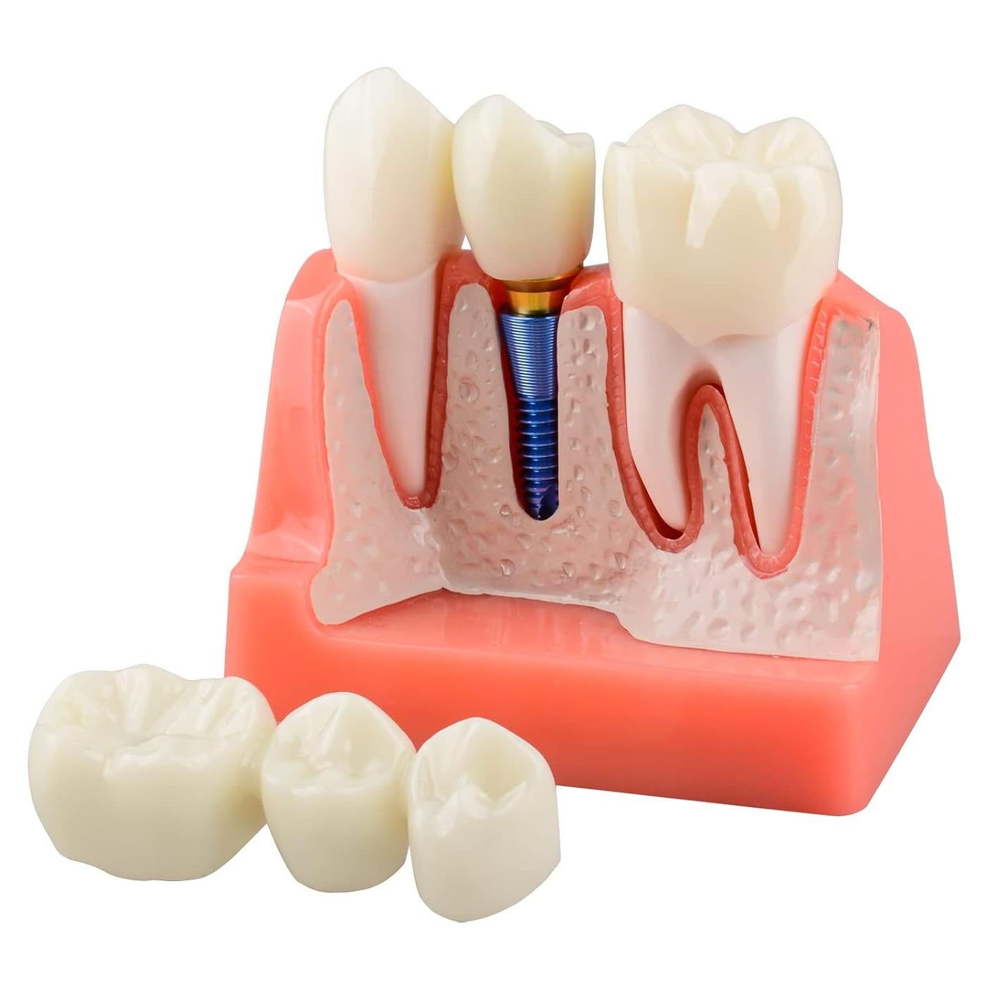 Modelo de Implante Dental Ultrassist 4X con Corona y Puente