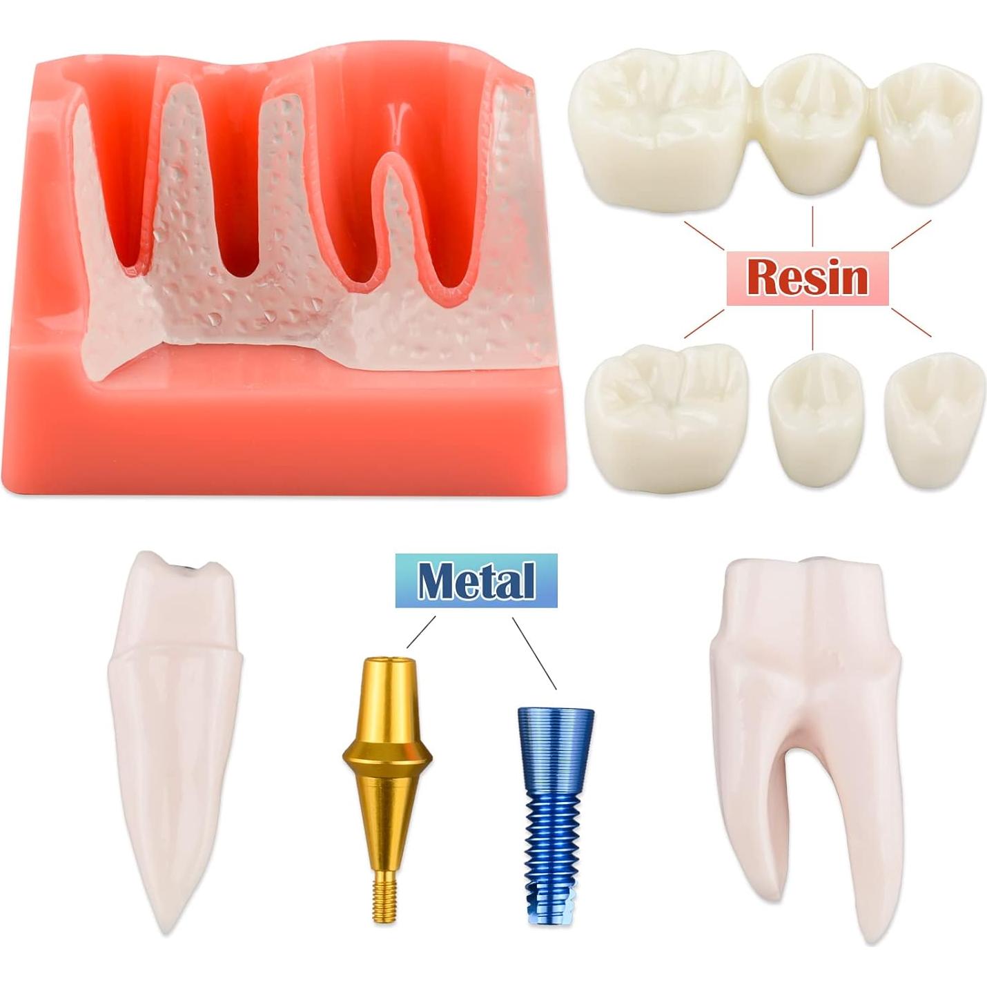 Modelo de Implante Dental Ultrassist 4X con Corona y Puente