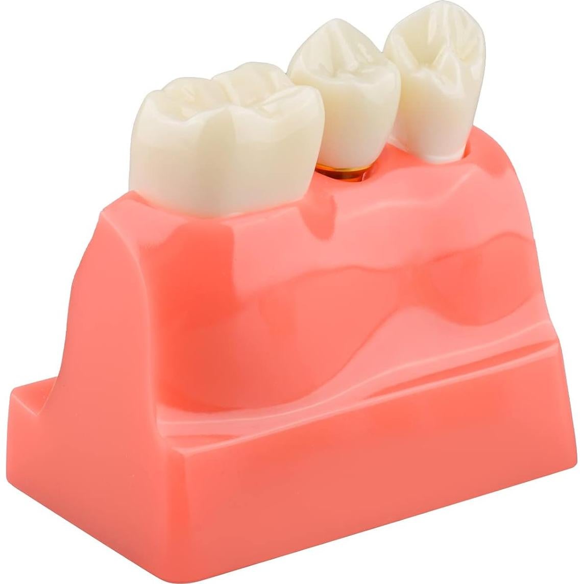 Modelo de Implante Dental Ultrassist 4X con Corona y Puente