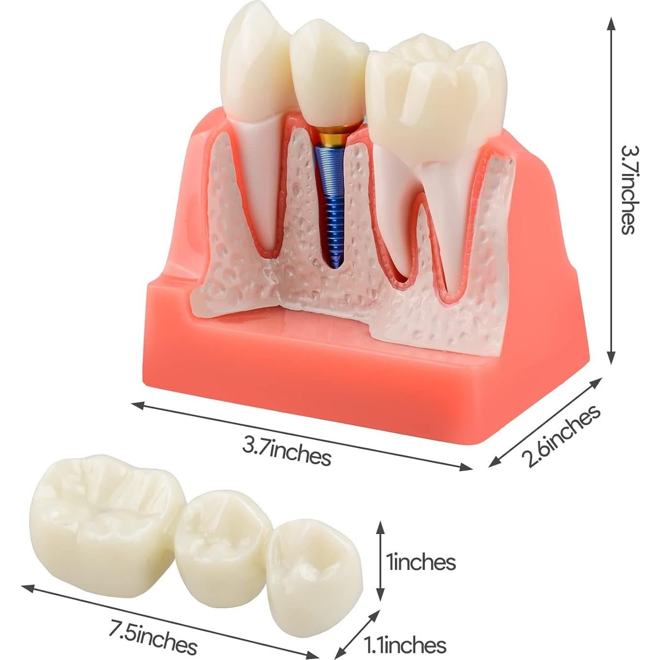 Modelo de Implante Dental Ultrassist 4X con Corona y Puente