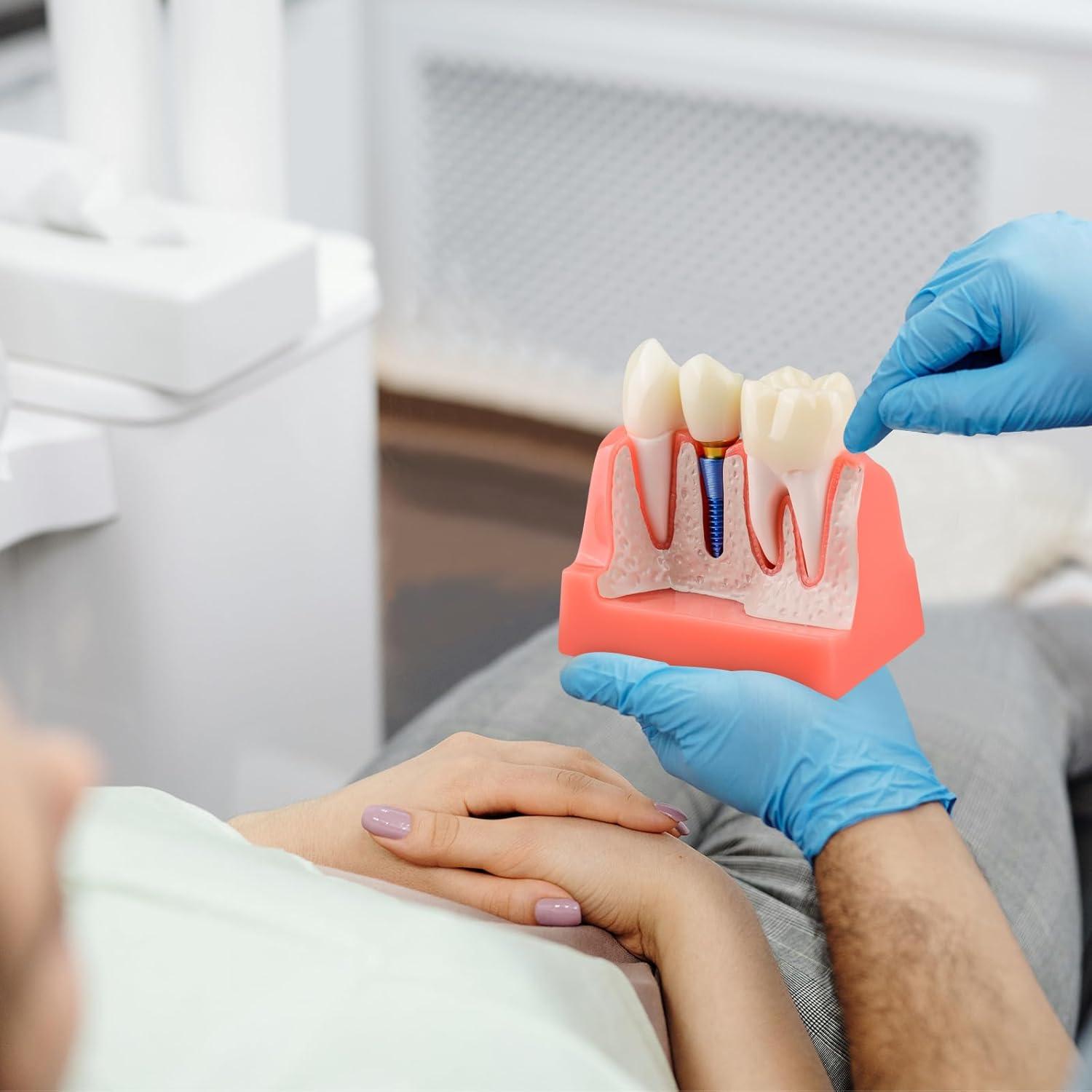 Modelo de Implante Dental Ultrassist 4X con Corona y Puente