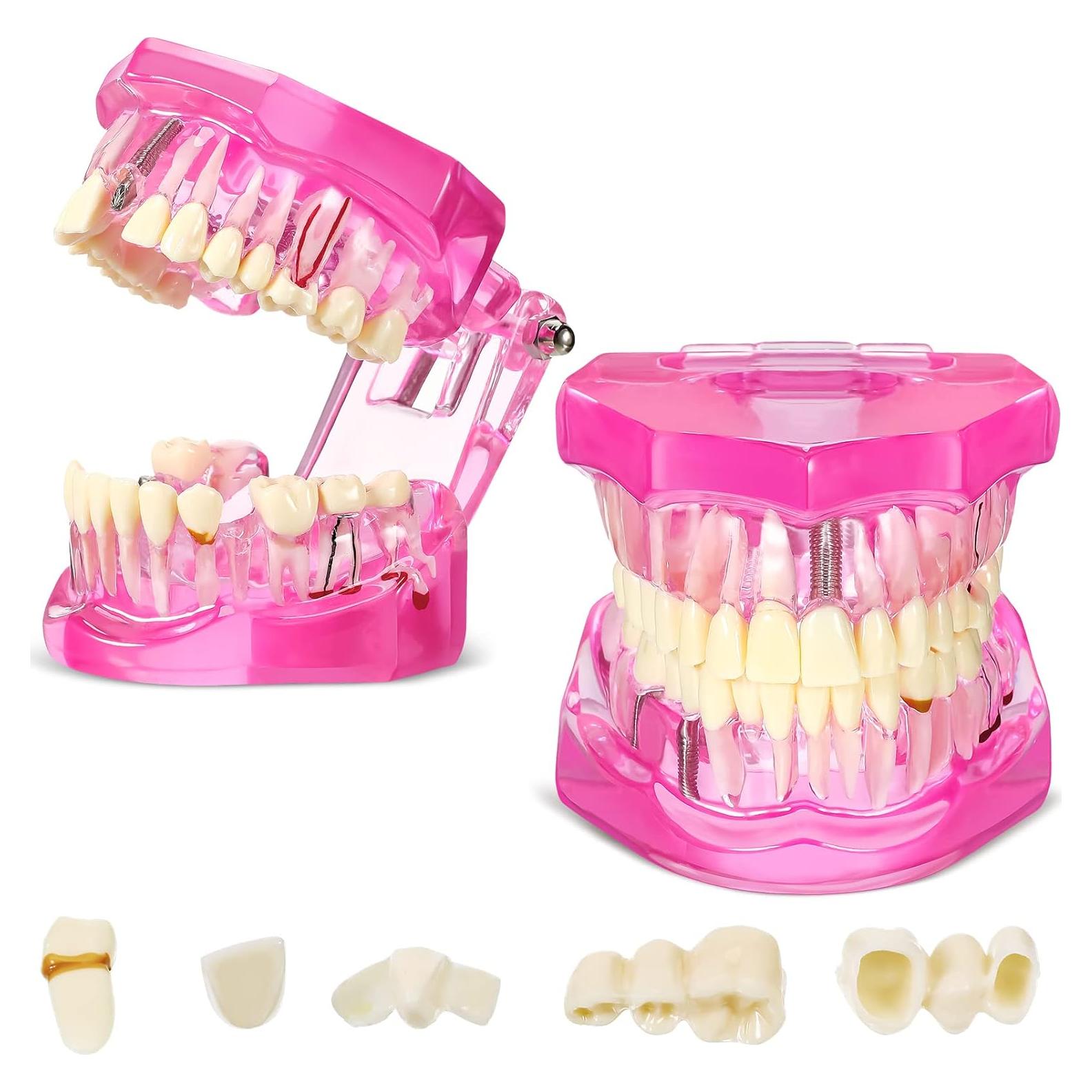 Modelo de Dientes Patológicos Outus Rosa 2 Piezas para Educación Dental