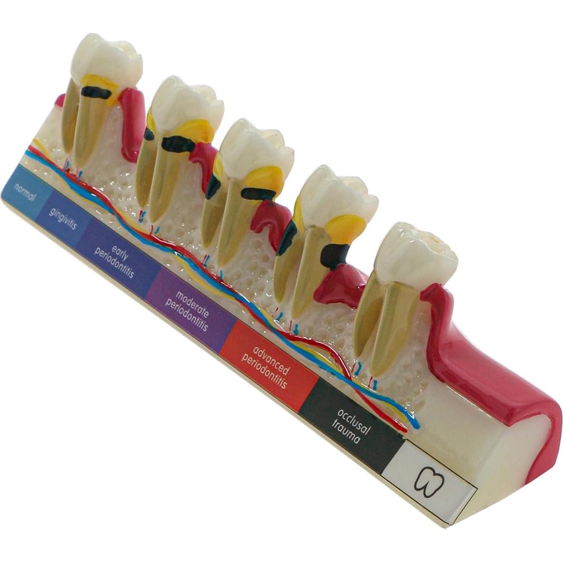 Modelo Dental 6 Etapas Enfermedad Periodontal Sprucedent