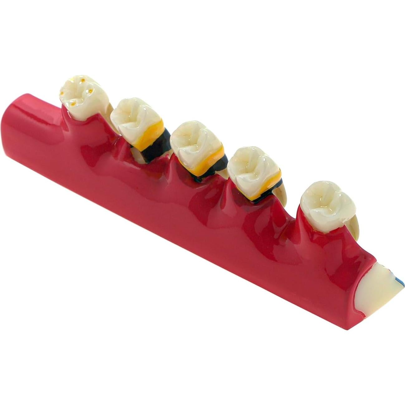 Modelo Dental 6 Etapas Enfermedad Periodontal Sprucedent