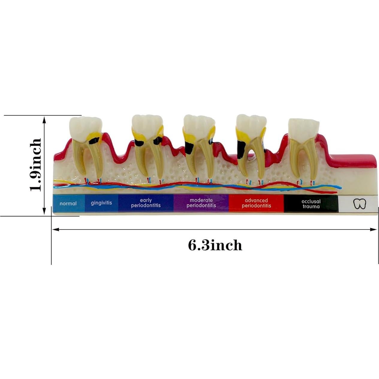 Modelo Dental 6 Etapas Enfermedad Periodontal Sprucedent