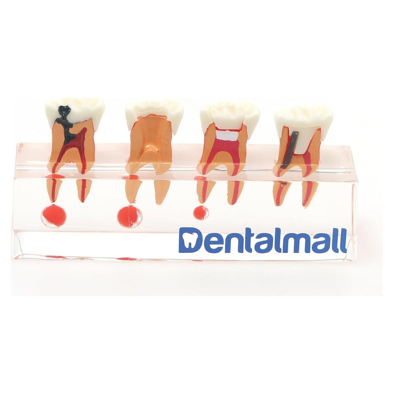 Modelo de Diente 4018 XINGXING Tratamiento Endodóntico 4 Etapas