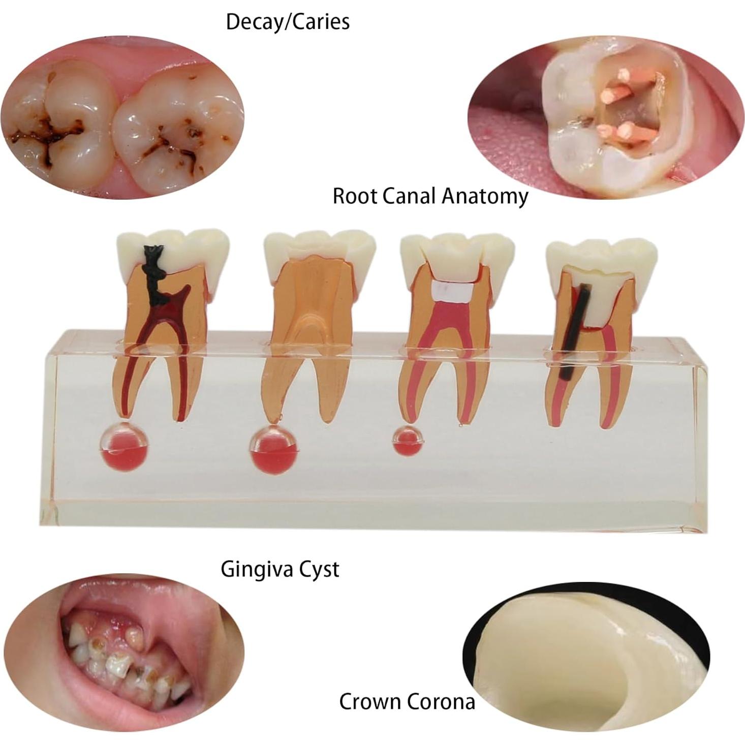 Modelo de Diente 4018 XINGXING Tratamiento Endodóntico 4 Etapas
