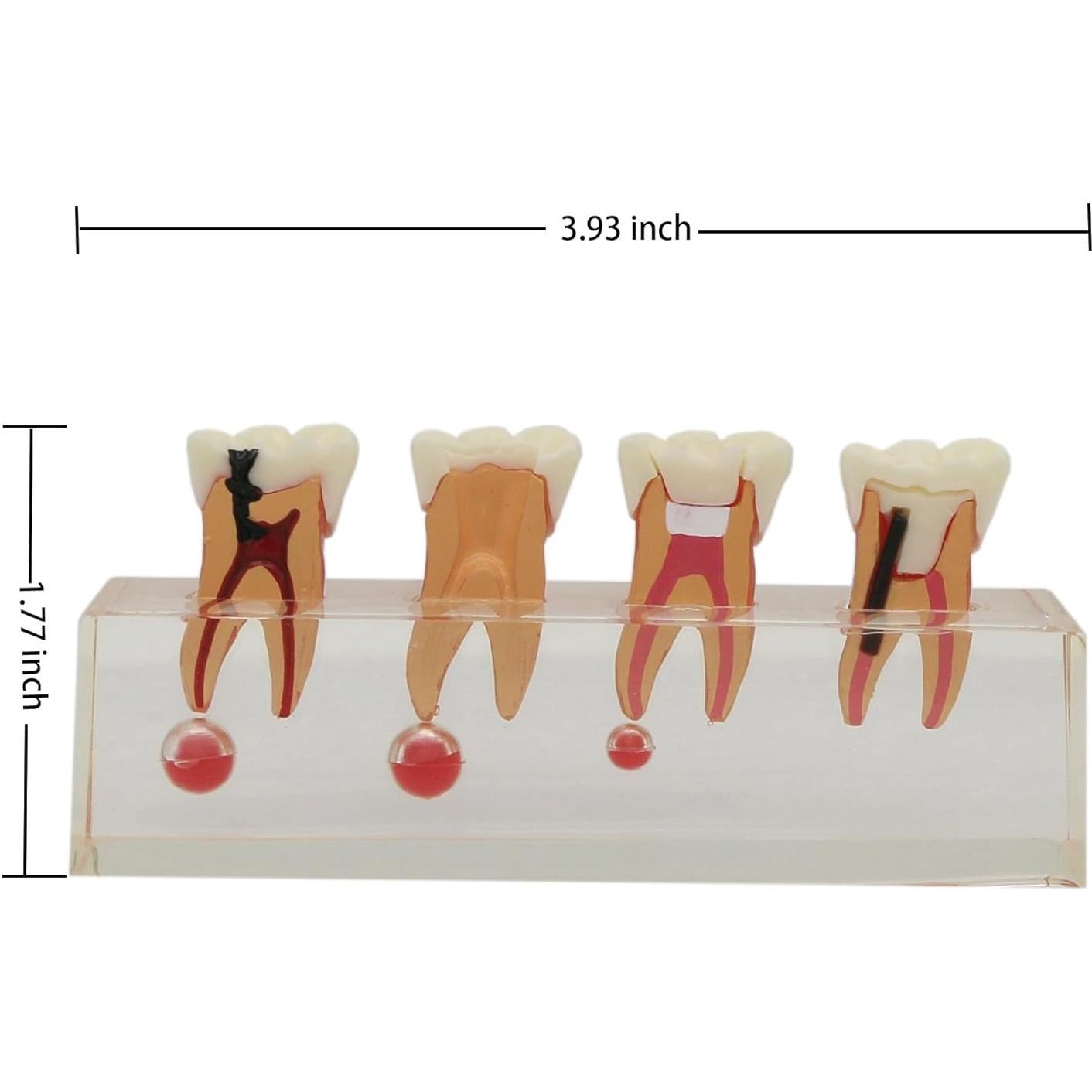 Modelo de Diente 4018 XINGXING Tratamiento Endodóntico 4 Etapas