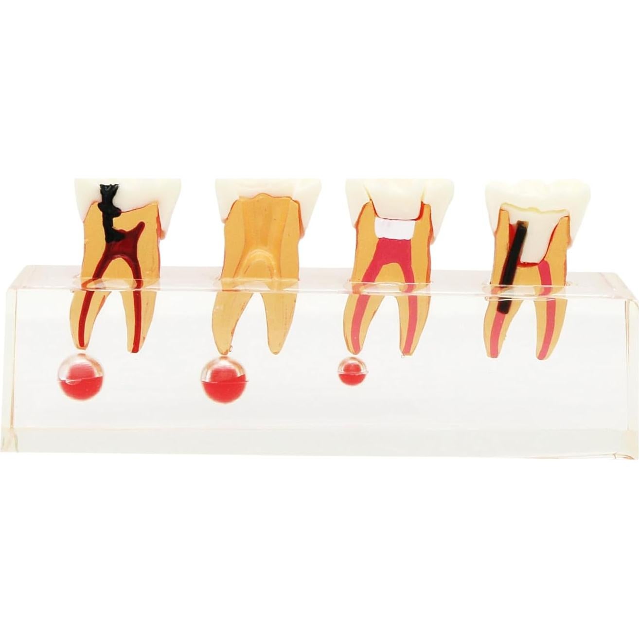 Modelo de Diente 4018 XINGXING Tratamiento Endodóntico 4 Etapas