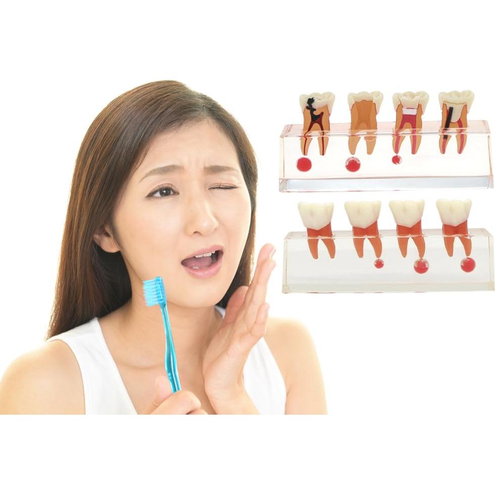 Modelo de Diente 4018 XINGXING Tratamiento Endodóntico 4 Etapas