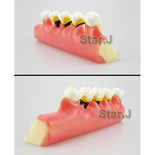 Modelo Typodont de Dientes Periodontales Airgoesin - Nuevo