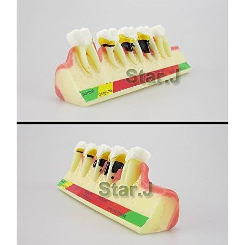 Modelo Typodont de Dientes Periodontales Airgoesin - Nuevo