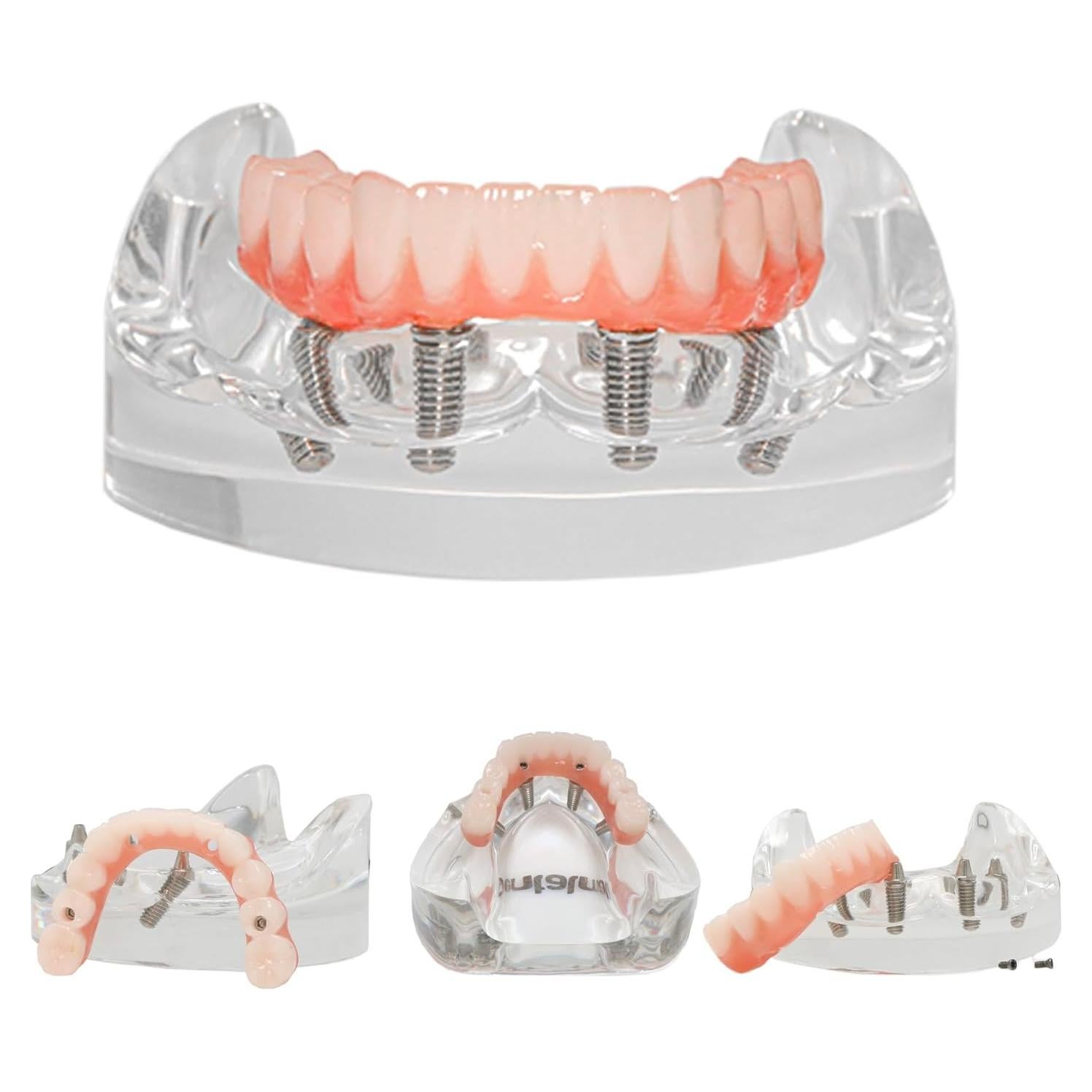Modelo de Implante Dental Typodont Transparente All-on-4
