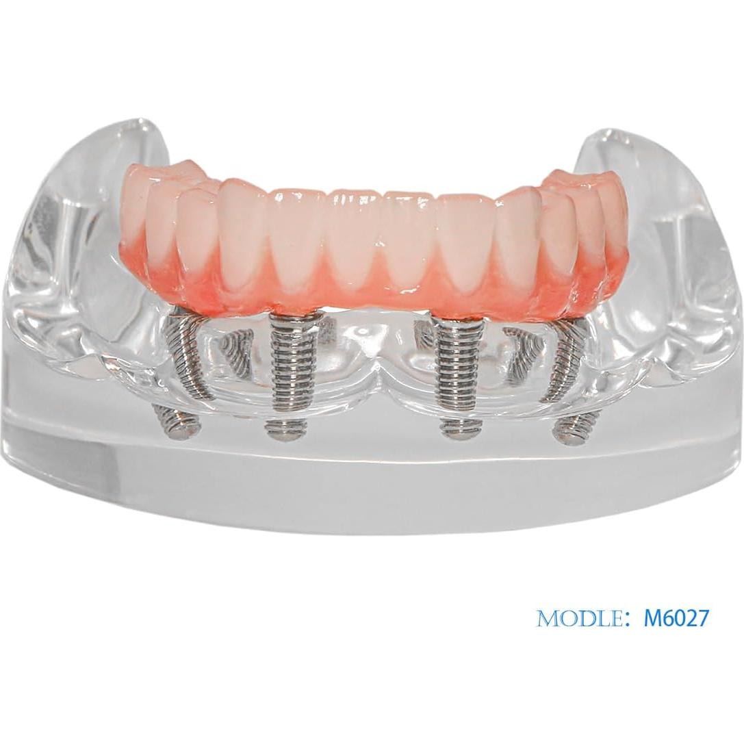 Modelo de Implante Dental Typodont Transparente All-on-4