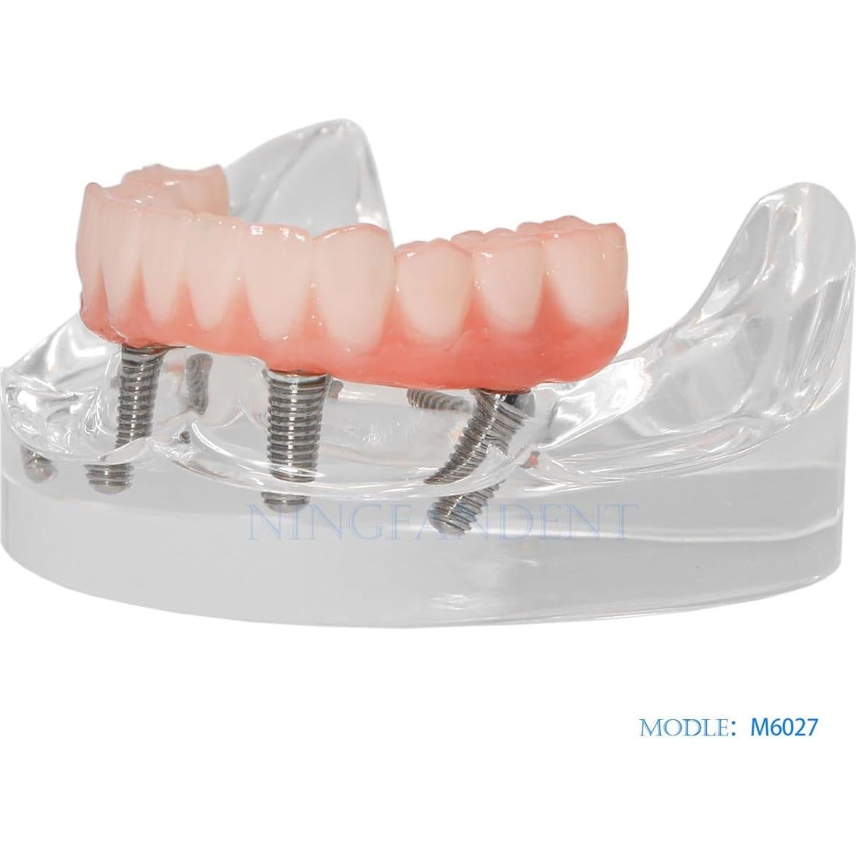 Modelo de Implante Dental Typodont Transparente All-on-4