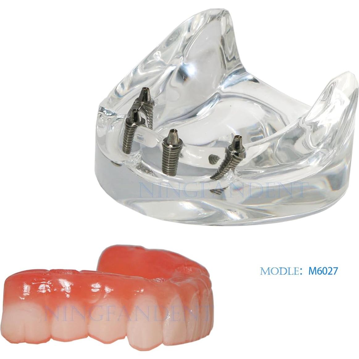 Modelo de Implante Dental Typodont Transparente All-on-4