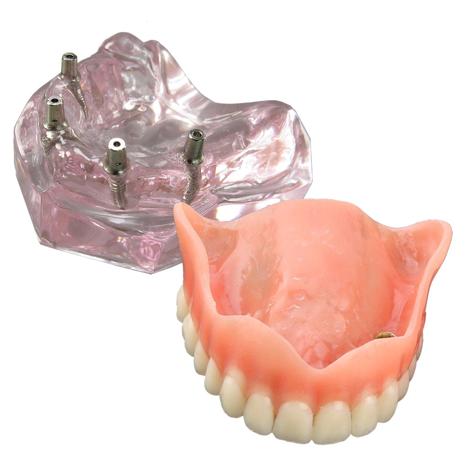 Modelo Dental Sobredentadura Superior Smile1000 4 Implantes