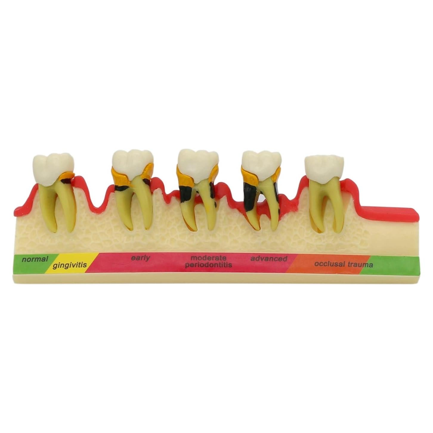 Modelo Typodont Dentalmall 4010 para Enfermedad Periodontal