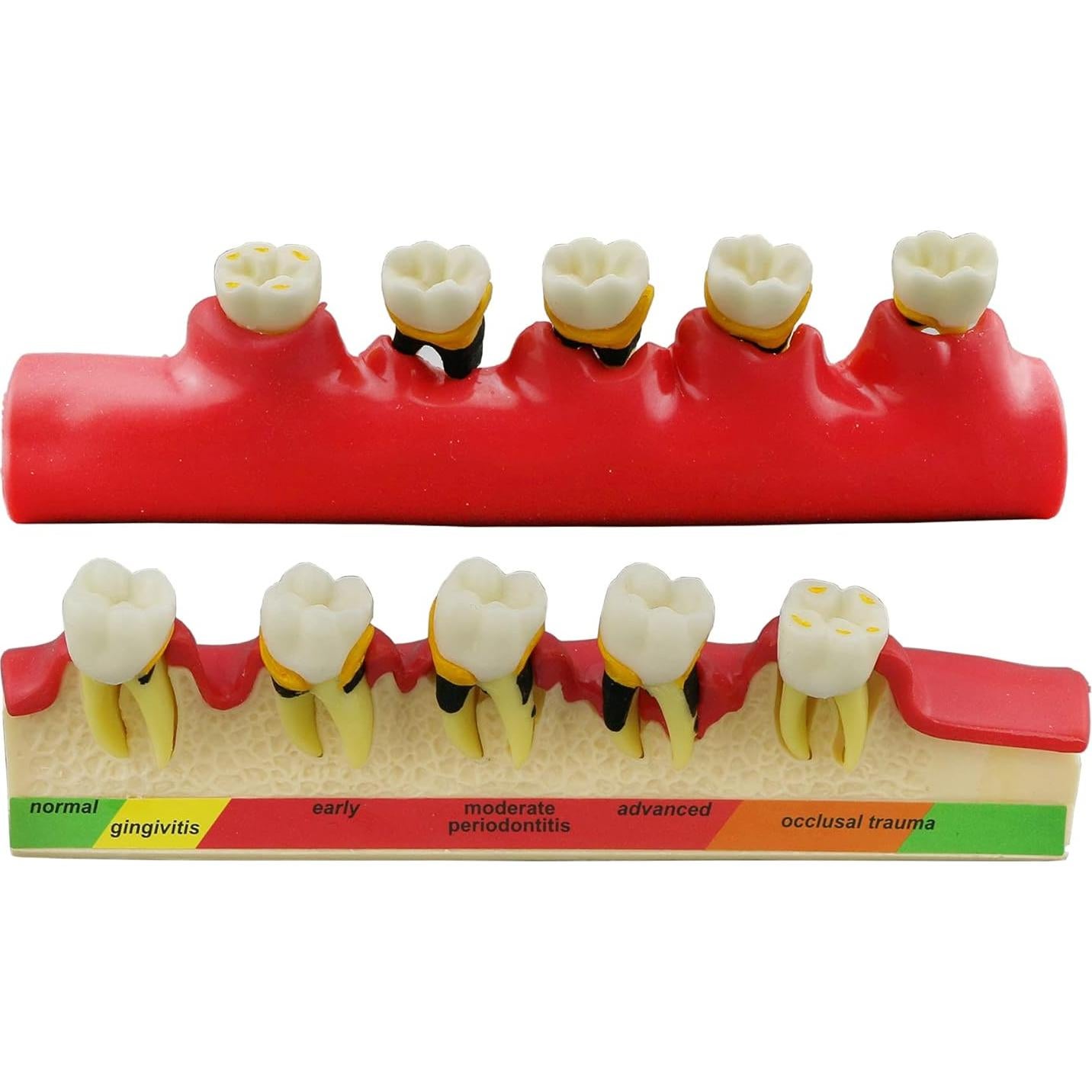 Modelo Typodont Dentalmall 4010 para Enfermedad Periodontal