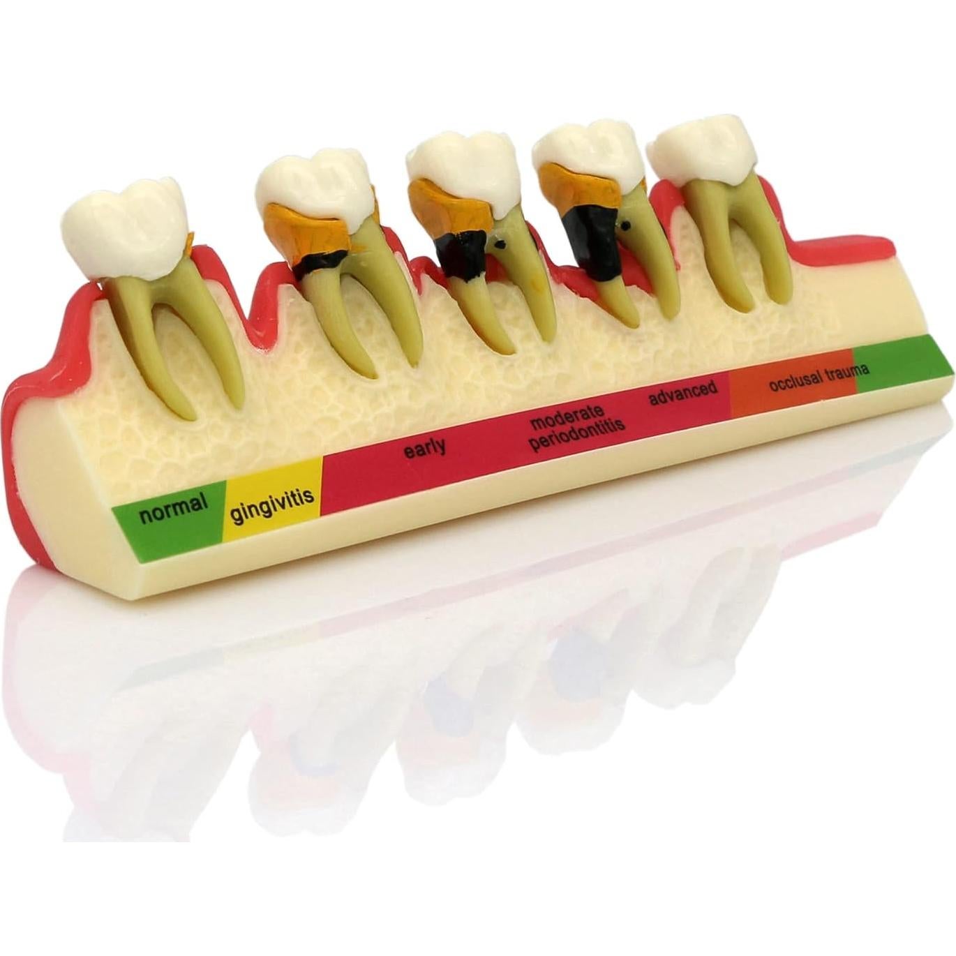 Modelo Typodont Dentalmall 4010 para Enfermedad Periodontal