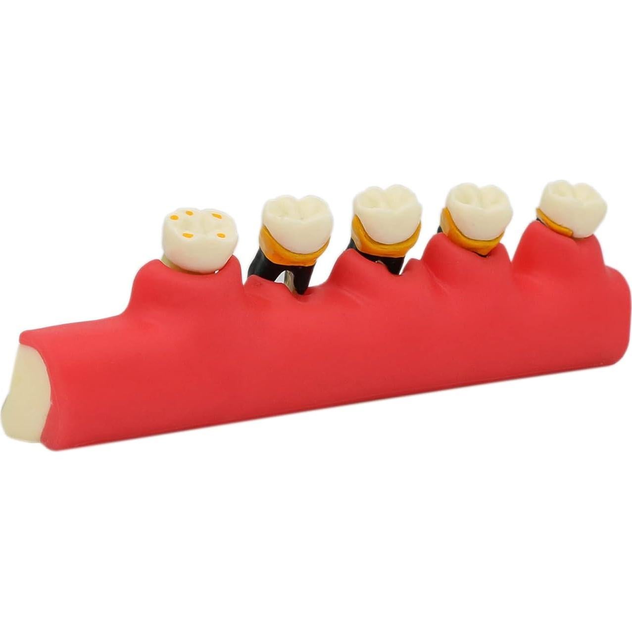 Modelo Typodont Dentalmall 4010 para Enfermedad Periodontal
